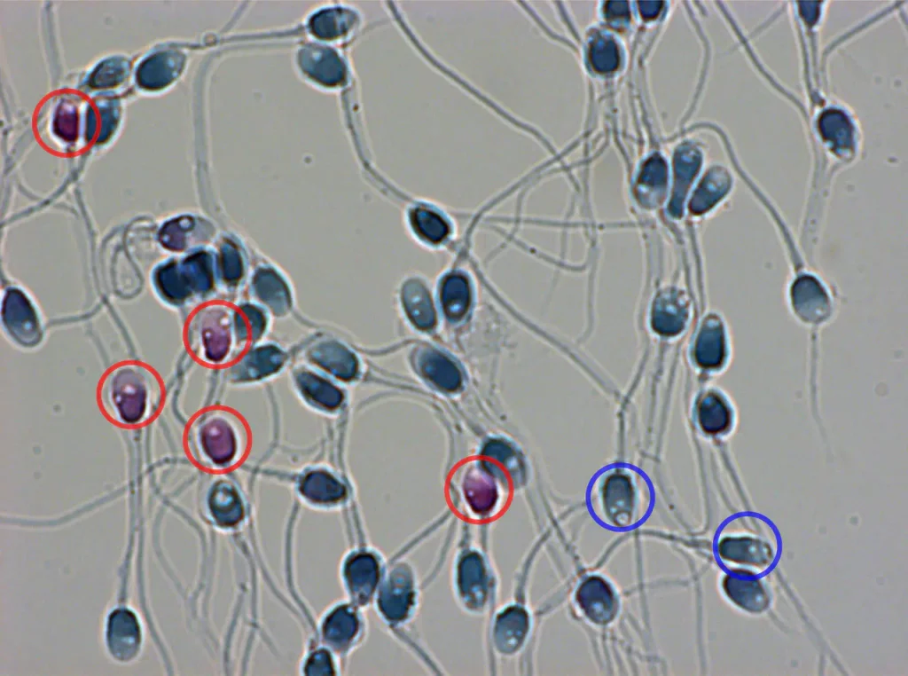 赤〇：細胞膜が切れているため赤色に染まった精子　青〇：精子頭部に空胞を認めるものの、細胞膜は正常な精子